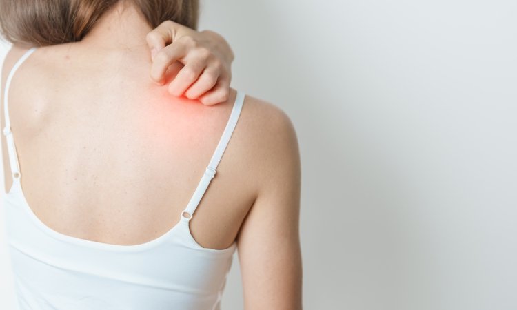 Rückenansicht einer Person im weißen Trägertop; sie kratzt sich am oberen Rücken/Schulterbereich, der gerötet ist